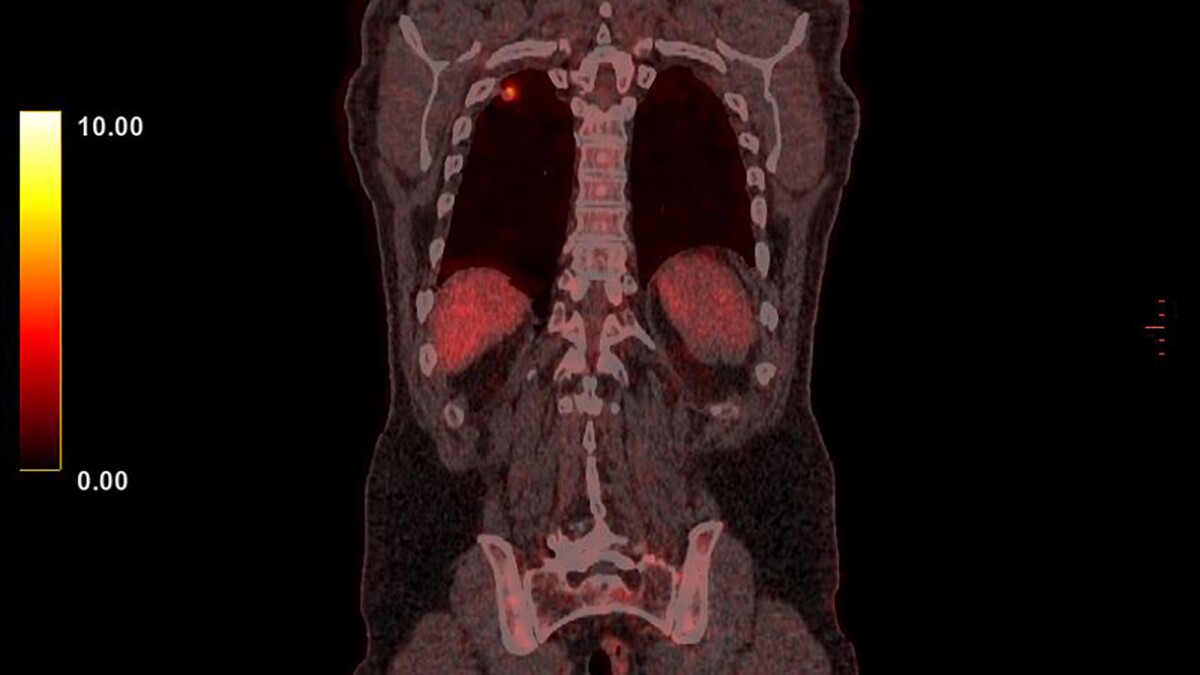 Immunotherapy drug proves promising for deadly small cell lung cancer